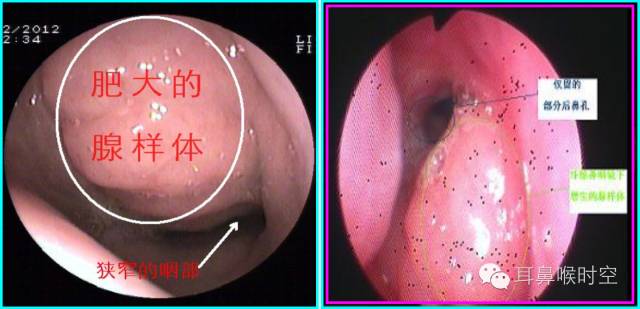 鼻咽肿物照片图片