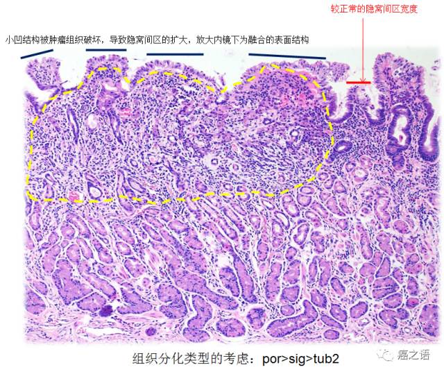 直肠印戒细胞癌图片