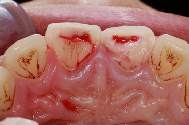 微创美学修复一例口腔双频激光微创序列治疗前牙外伤
