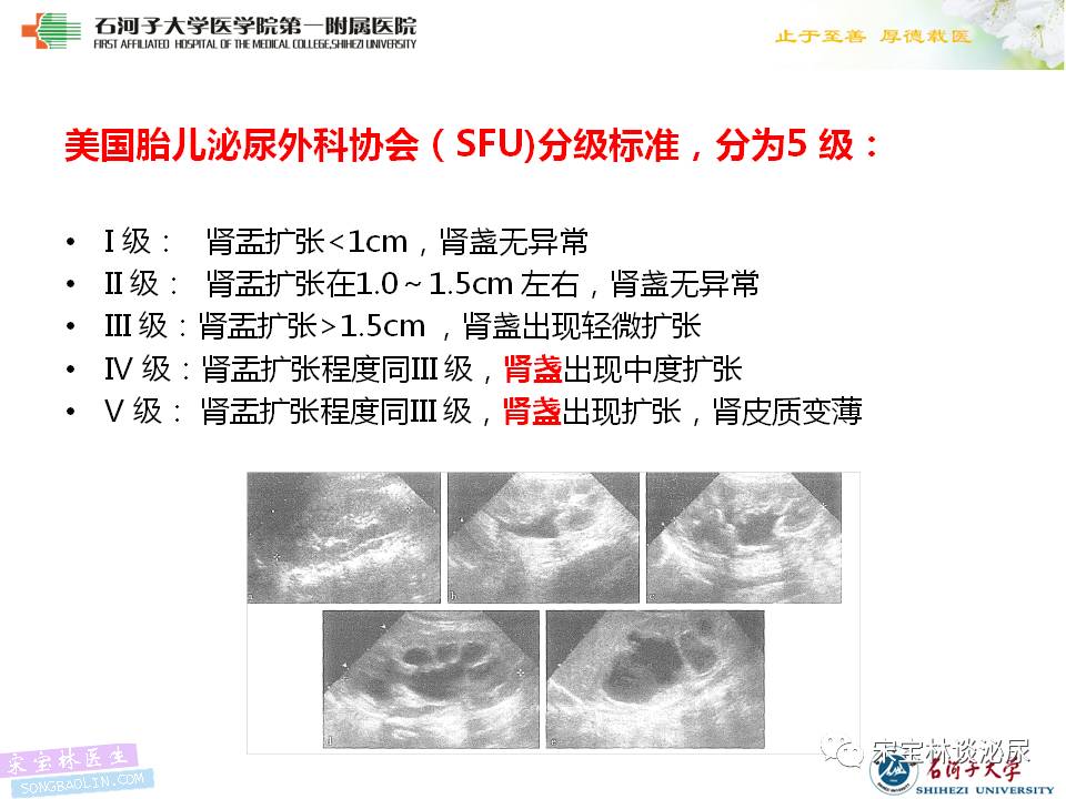 先天性upjo所致肾积水常见问题再认识