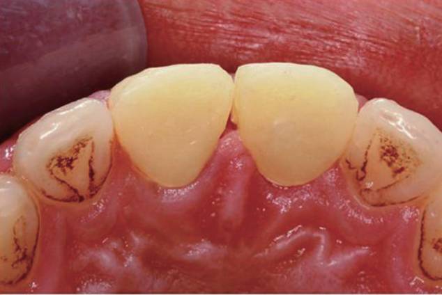 【微创美学修复一例】口腔双频激光微创序列治疗前牙外伤