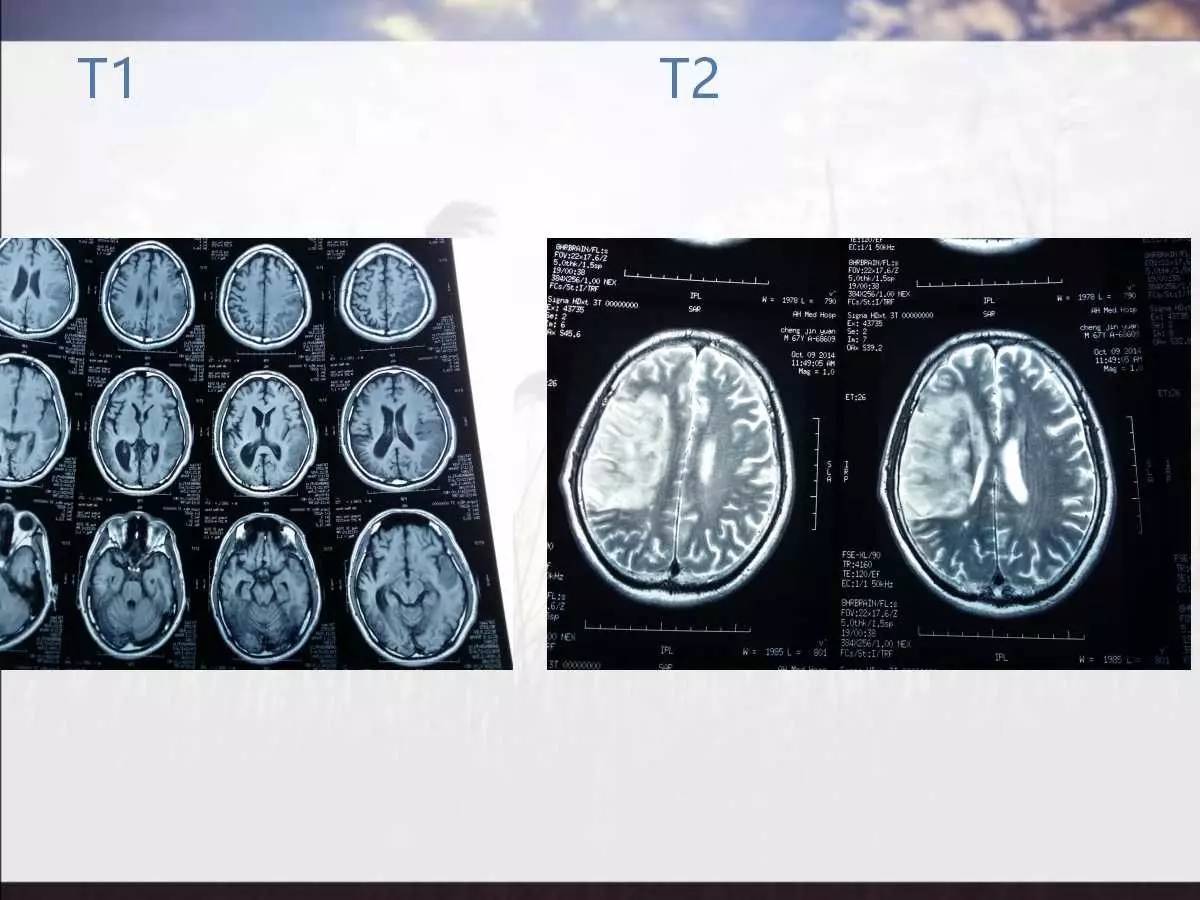 收藏| 頭顱核磁共振幾個成像的意義