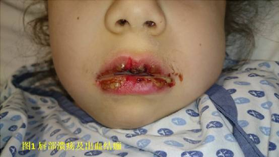婴儿肺炎嘴唇发青图片图片