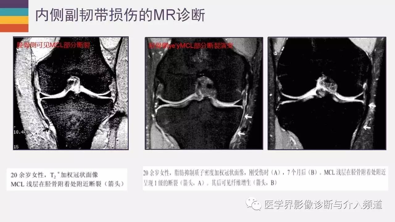内外侧副韧带MR图片