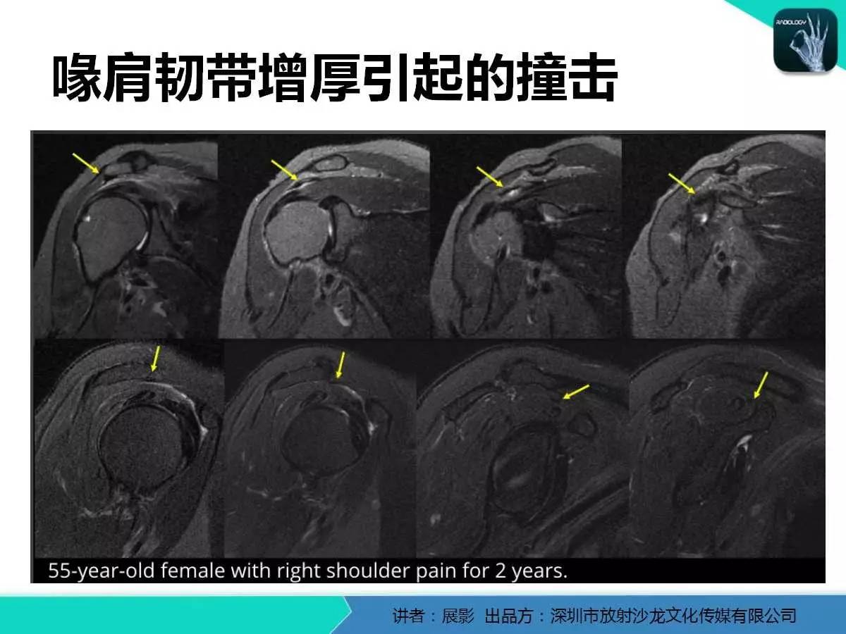 专家大讲堂肩峰下撞击综合征和肩袖损伤的mr表现