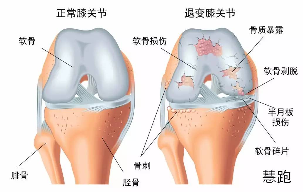 跑者发生的膝痛多种多样,比如髌股关节疼痛综合征,髂胫束摩擦综合征
