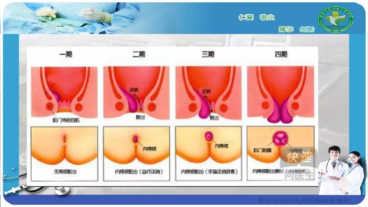 痔疮分几种类型图片图片