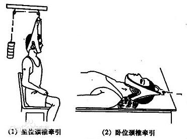 颈椎病的牵引疗法 颈椎病的牵引治疗方法和适应症