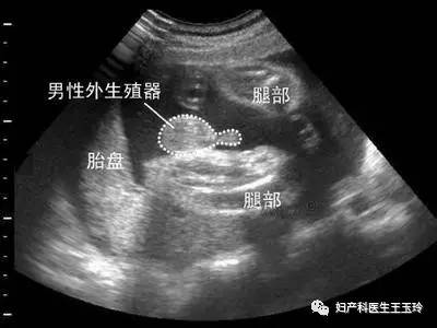 17周胎儿性别图图片