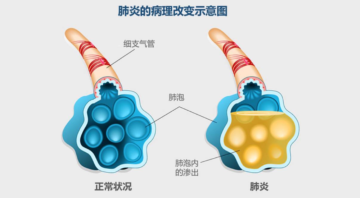 感冒,肺炎,傻傻地分不清楚?比起咳嗽時長,更該關注的是起因