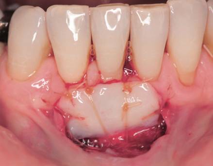 几种组织瓣都适用;而上颌牙牙龈严重退缩时,只有结缔组织瓣或转移瓣结