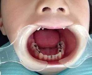 粘连在宝宝牙齿表面,致使越来越多的细菌滋生,从而形成龋齿