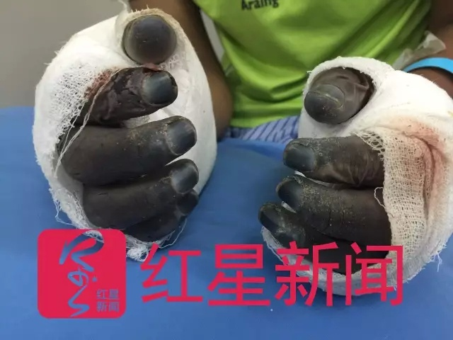 登山者倒在珠峰8600米无法动弹 双手冻坏似熊掌