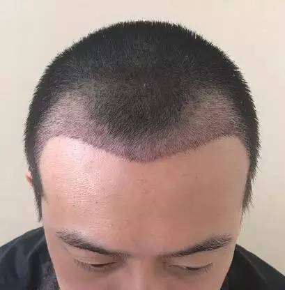 图为吴先生额角种植后一周的照片,前额秃顶的位置长出了头发看见两边