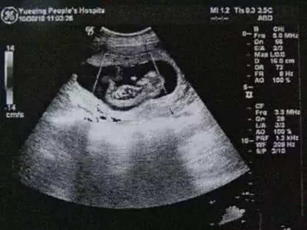 九十天男孩的胎儿图图片