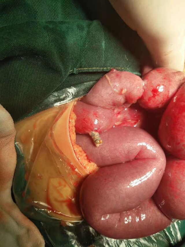 配图是一张片子和两张手术图,能清晰看到穿破肠道的小磁铁