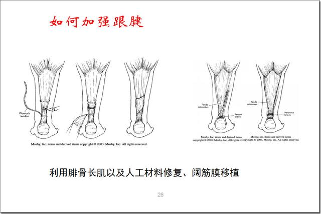 要积极手术治疗急性跟腱断裂