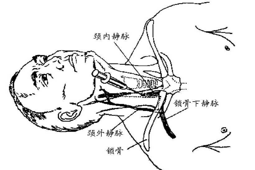 颈静脉穿刺解剖图图片