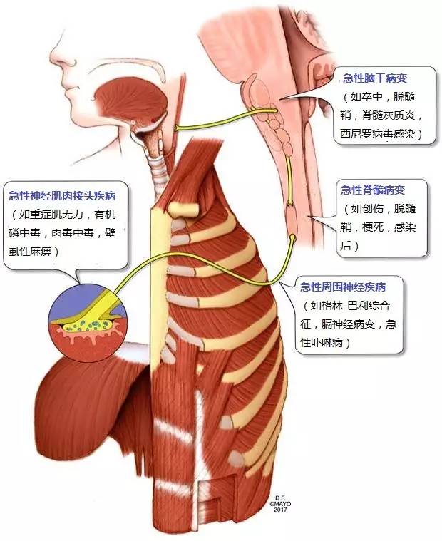 (五)引起呼吸衰竭的神经系统急重症3)急性低位颈胸段脊髓损伤时,膈肌