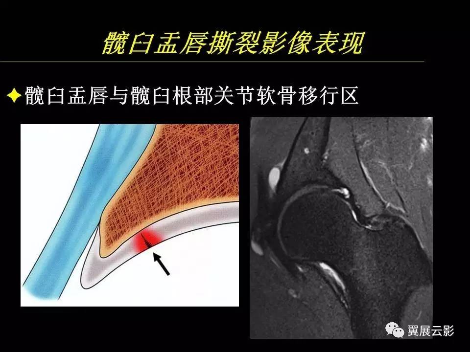 【专家课堂课后整理】髋关节撞击综合征和盂唇损伤的mr诊断