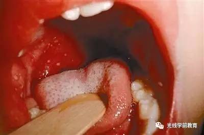 特征为急起的发热和喉痛,在软腭的后部,咽,扁桃体等处可见红色的晕斑