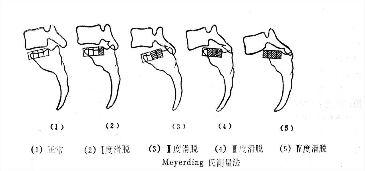 椎体滑脱分度详细图解图片