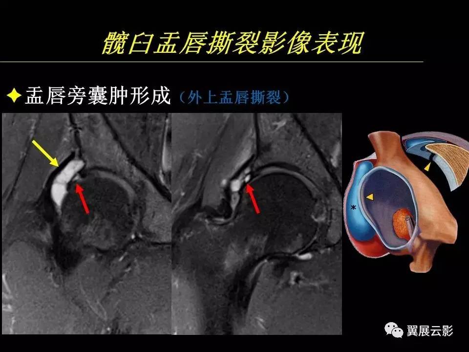 髋部盂唇图片