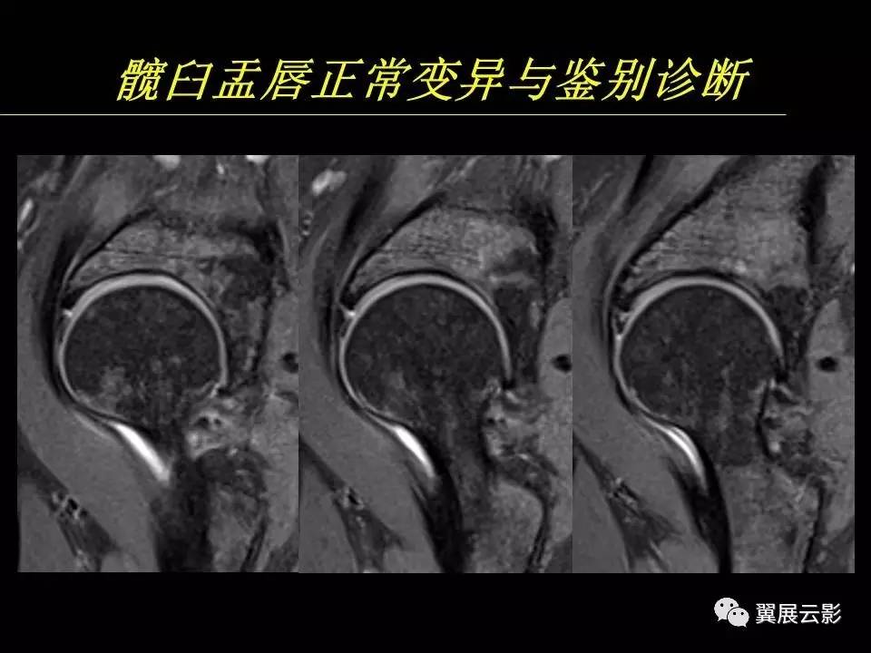 【专家课堂课后整理】髋关节撞击综合征和盂唇损伤的mr诊断