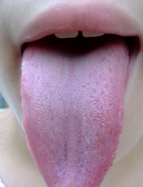 舌头紫色是什么原因图片