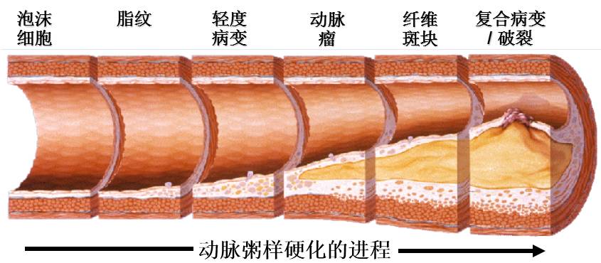 血脂与动脉粥样硬化