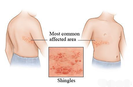 外阴很多水疱还特疼以为是单纯疱疹却是缠腰龙