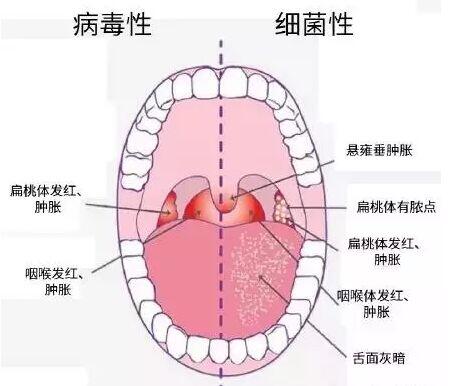 扁桃体发炎是什么症状图片