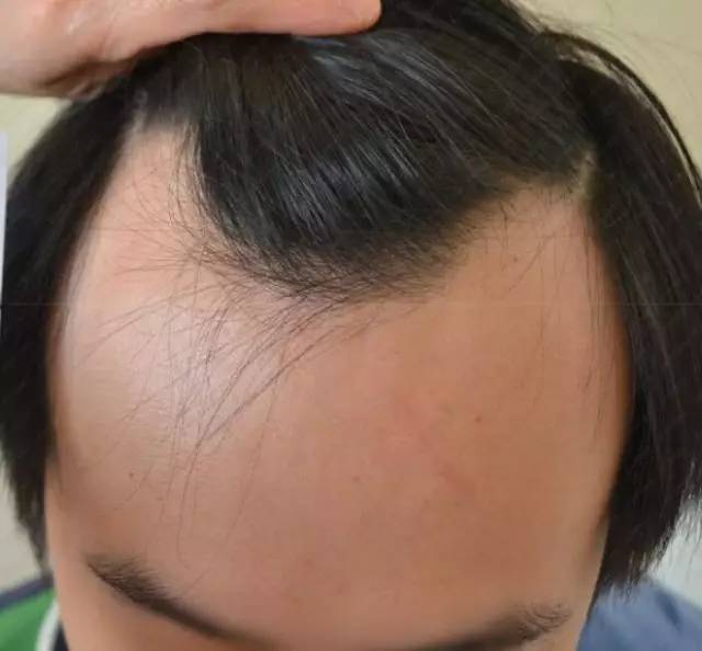 两边额角和发际线明显后退图为吴先生额角种植后一周的照片,前额秃顶