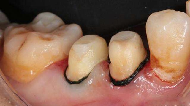 使牙龈边缘变黑4)牙龈退缩会造成烤瓷冠边缘及牙根显露出来,牙龈边缘