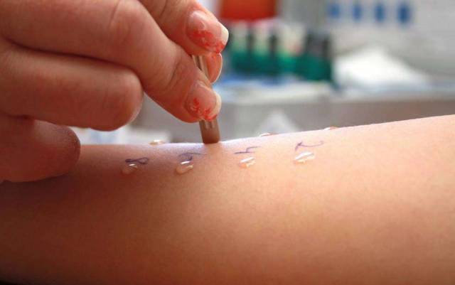 点刺试验能检查近二十种过敏原,如常见的尘螨,花粉,霉菌,动物毛等