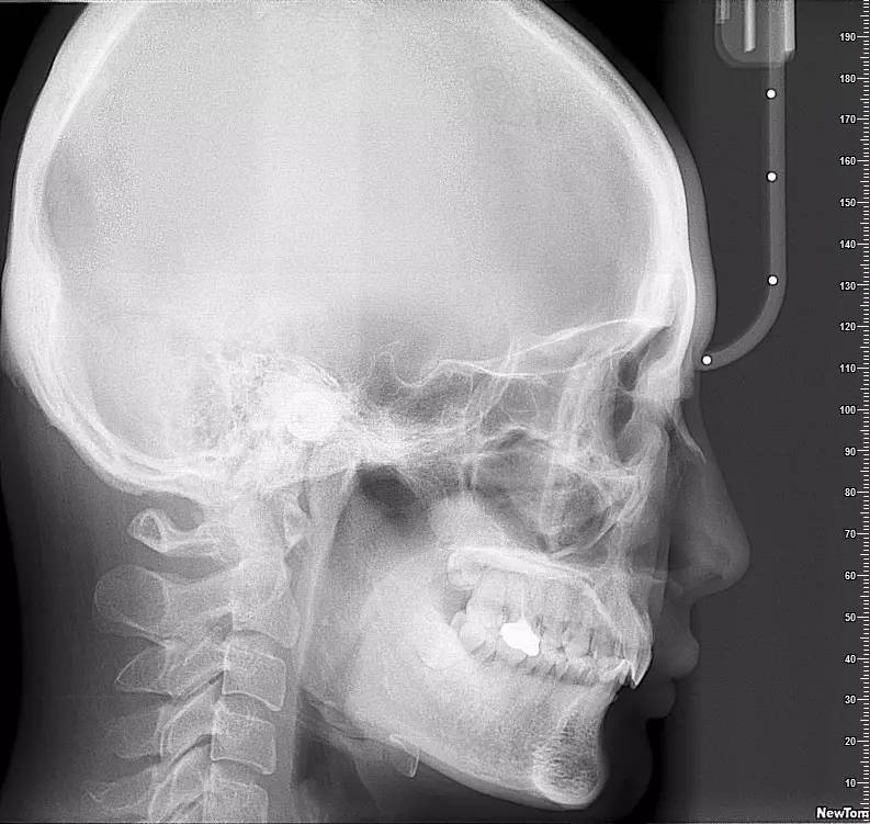 徐医生给我拍的x光片……这个骷髅是我……对不起大家,就是展示一下我