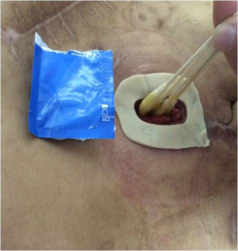 病例分享第五期:造口附件套装(粉膜环)在造口黏膜分离病人中的应用