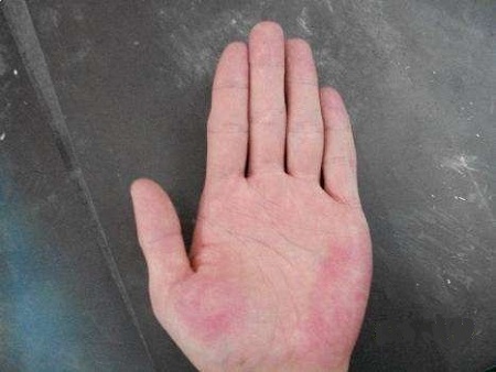 手掌发红别忽视可能是这种疾病