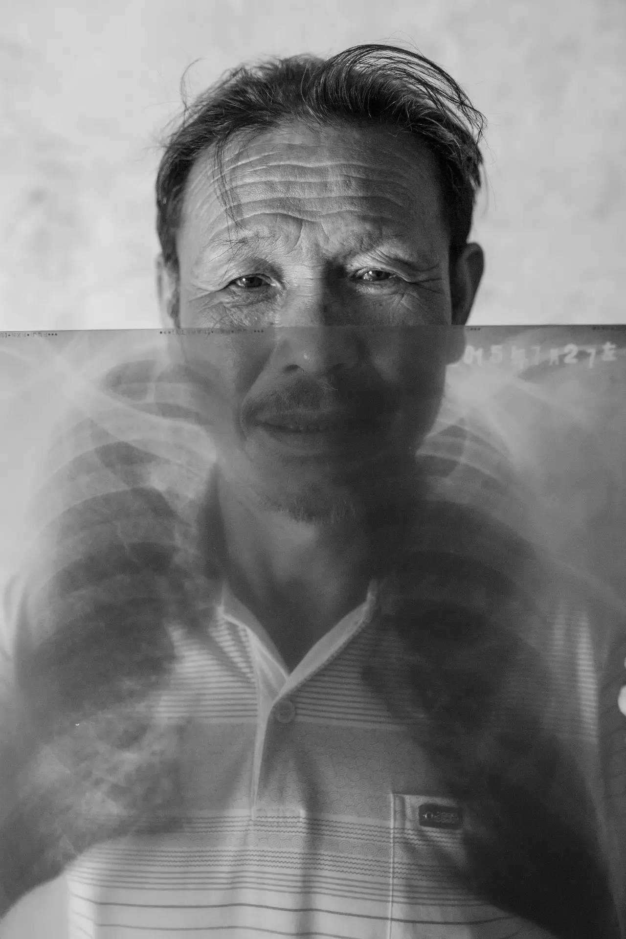 尘肺病晚期图片图片