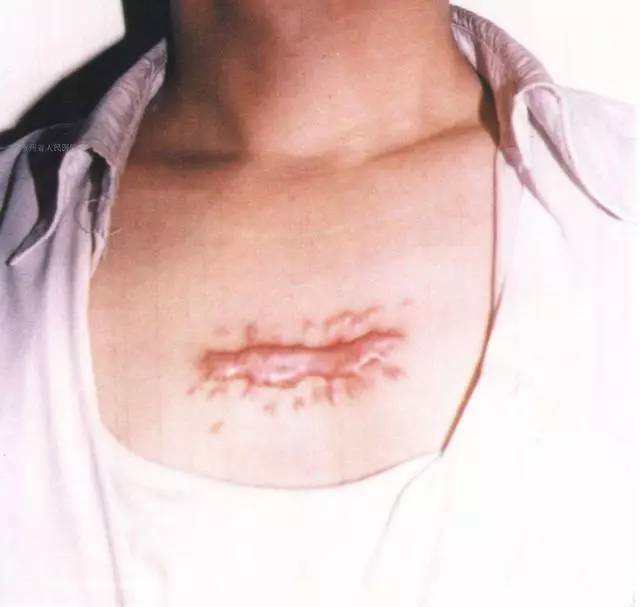 宫颈癌手术刀疤图片图片
