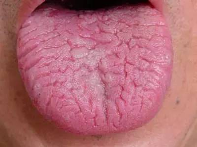 口腔科医生教你看舌头知疾病