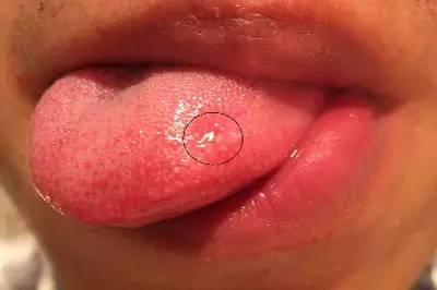 口腔科医生教你看舌头知疾病