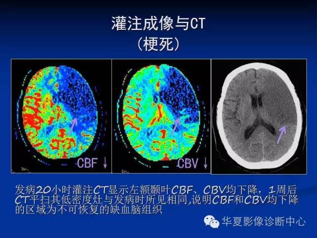 ct灌注成像图像解读图片