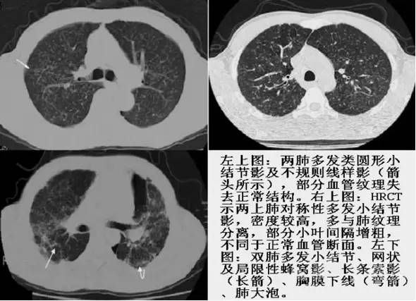 如何看懂肺癌CT图片图片