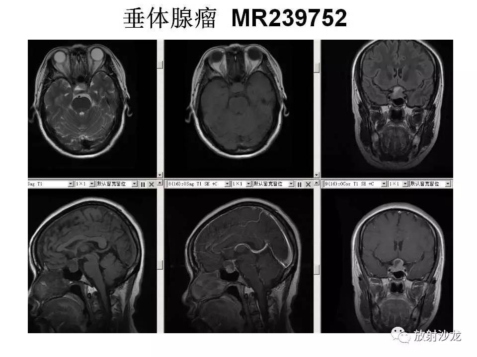 垂体微腺瘤mri图像图片