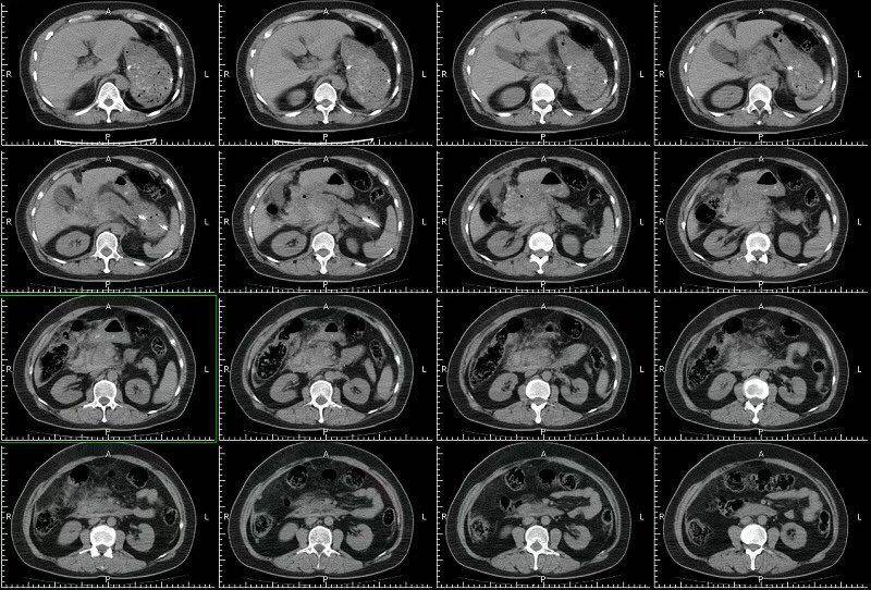 通過對比ct檢查圖像,該例ct圖像也提示了十二指腸損傷的徵象,也為臨床