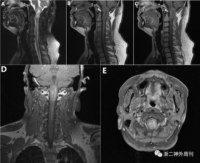 颈椎室管膜瘤图片