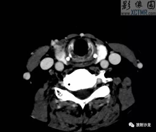 甲状腺癌ct表现图片
