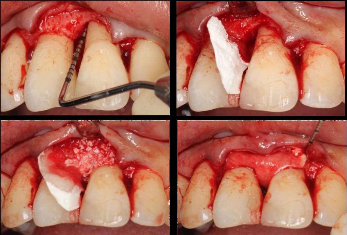 口腔跨学科治疗中的规范化牙周治疗程序——一例重度慢性牙周炎患者的