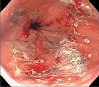 暗红色的血肠癌图片